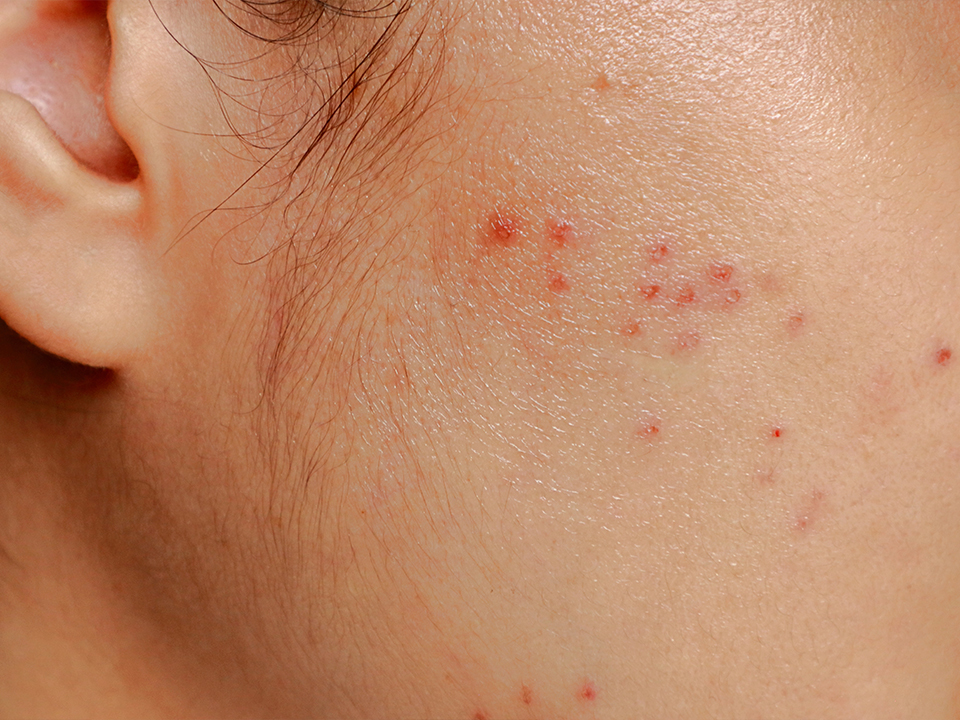 Täiskasvanuea nahaprobleemid pärast hormonaalse kontratseptsiooni kasutamise lõpetamist